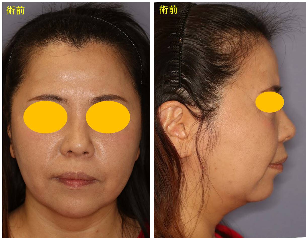 顔面の脂肪吸引の経過 1m と効果 顎下と頬の下 宮益坂クリニック