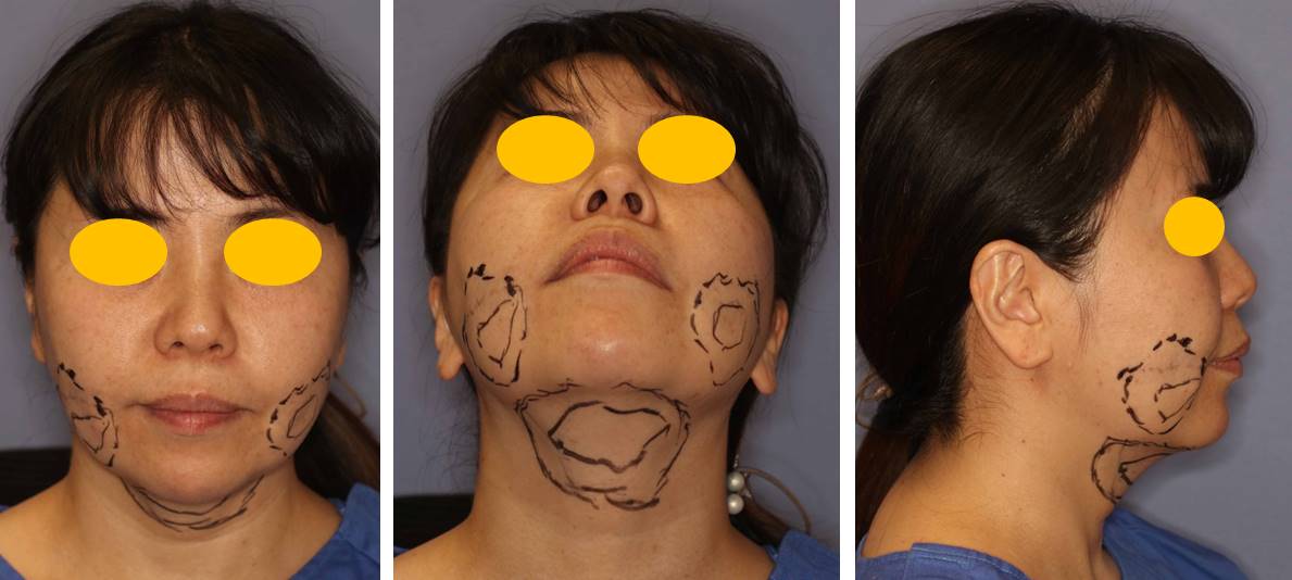 顔面の脂肪吸引の経過 1m と効果 顎下と頬の下 宮益坂クリニック
