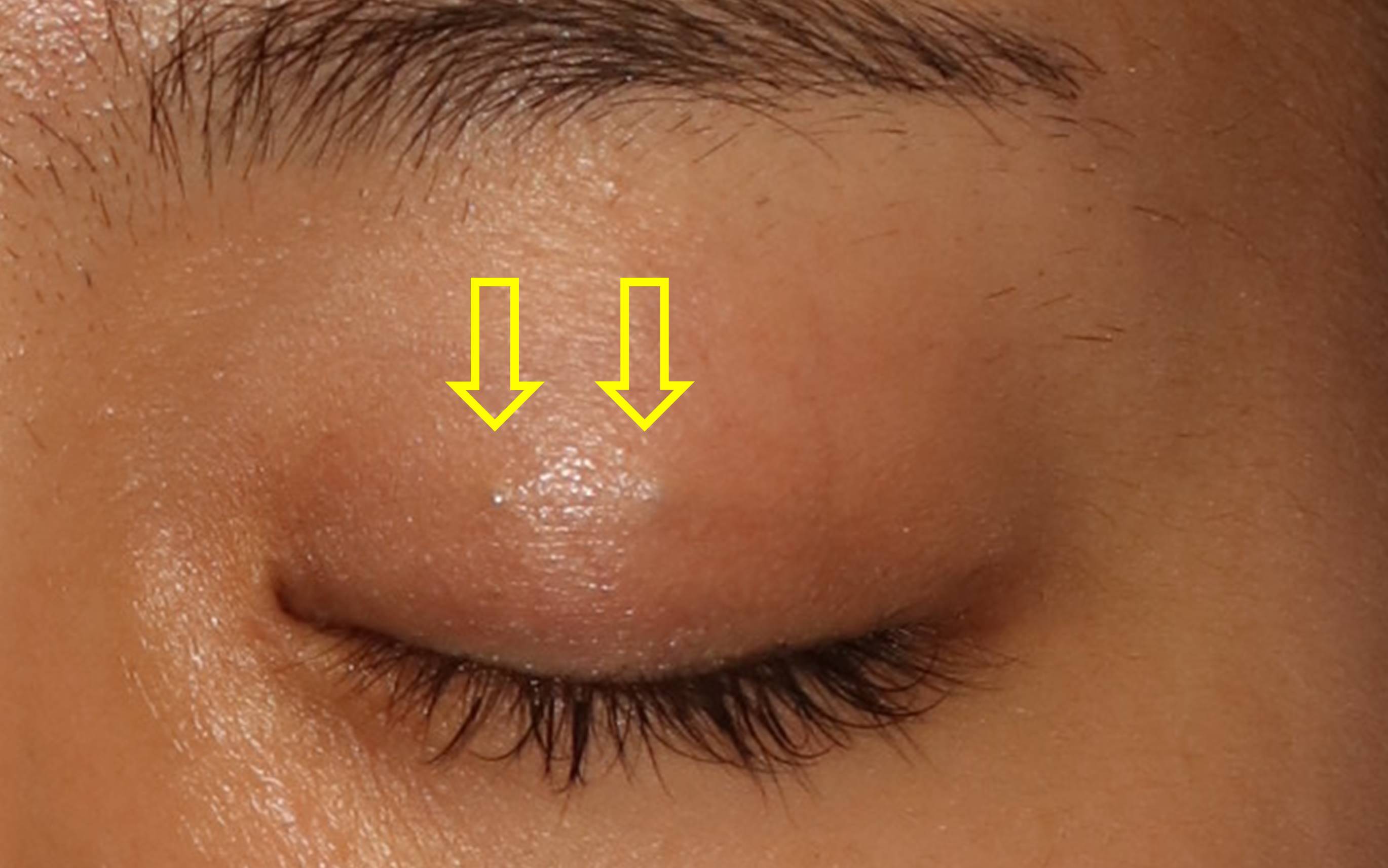埋没重瞼と目頭切開の修正 術後１か月の経過 宮益坂クリニック