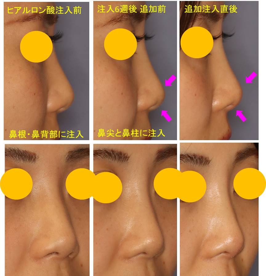 変わる 形 鼻 の 鼻を小さくする方法！鼻が大きいのは改善できる！美容家の教える簡単ケア