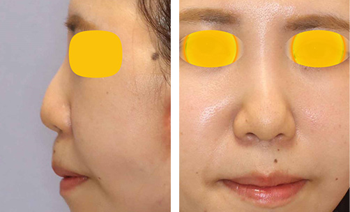 鼻中隔延長術＋鼻尖形成の症例写真（術前）