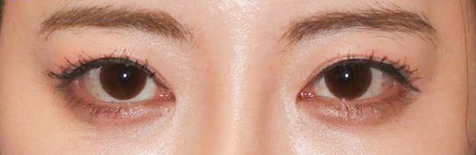 宮益坂クリニックの埋没法3点留め＋上眼瞼脱脂術の症例写真（術前）