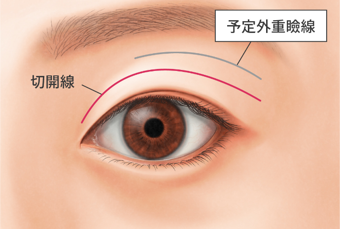 東京・渋谷の宮益坂クリニックの予定外重瞼線の防止や修正への対応