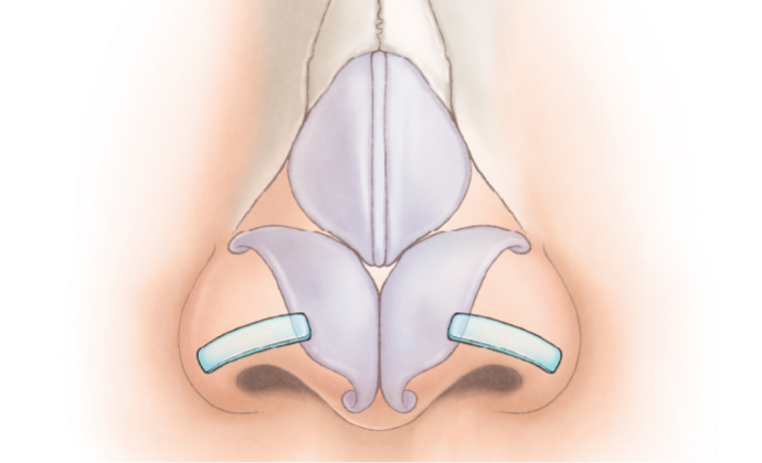 鼻孔縁下降術の治療のポイント