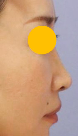宮益坂クリニックの鼻翼基部のヒアルロン酸注入の症例写真（術後）