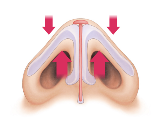 鼻尖の補強