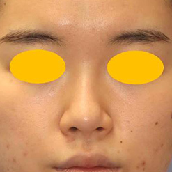 鼻中隔延長＋鼻尖縮小＋鼻尖軟骨移植＋隆鼻術の症例写真（術前）