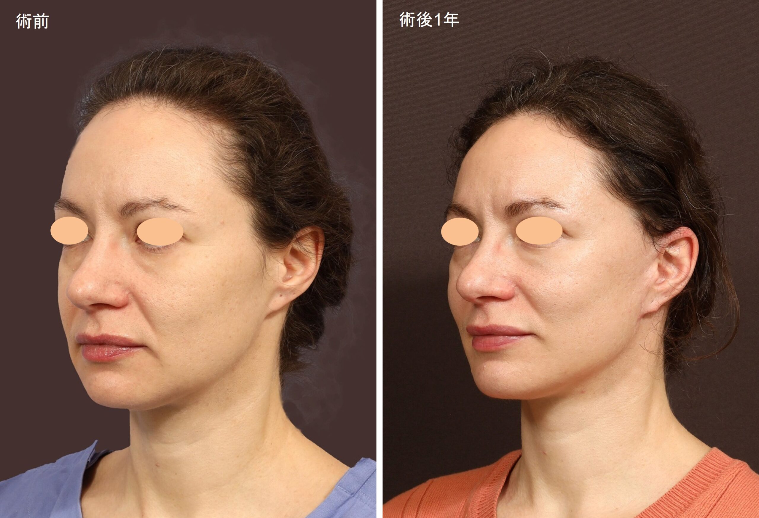 トータルフェイスリフトフル ～中顔面もフェイスラインも整える～|宮