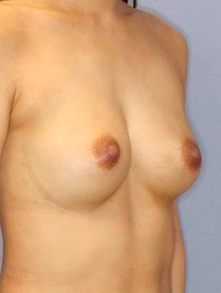 脂肪注入による豊胸術+乳頭縮小の症例写真（術後）
