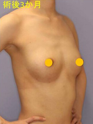 宮益坂クリニックの脂肪注入による豊胸の症例写真（術後）