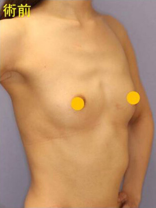 宮益坂クリニックの脂肪注入による豊胸の症例写真（術前）