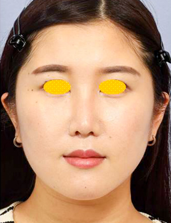 宮益坂クリニックのミニフェイスリフト（中顔面＋下顔面）の症例写真（術後）