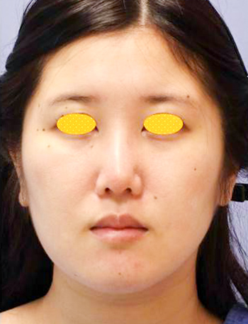 宮益坂クリニックのミニフェイスリフト（中顔面＋下顔面）の症例写真（術前）