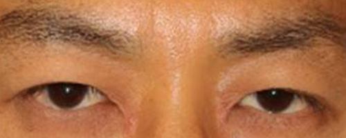 東京・渋谷の宮益坂クリニックの眼瞼下垂症（眉毛下切開術）の症例写真