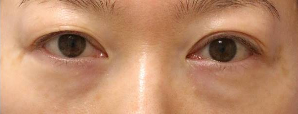 東京・渋谷の宮益坂クリニックの下眼瞼脱脂＋ヒアルロン酸注入の症例写真