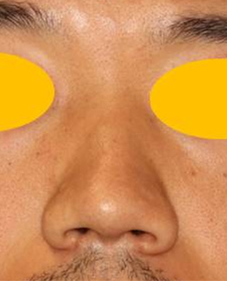 東京・渋谷の宮益坂クリニックの斜鼻の症例写真（術前）