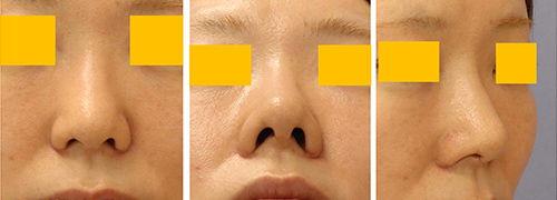 東京・渋谷の宮益坂クリニックの鼻翼縮小の症例写真（術後）
