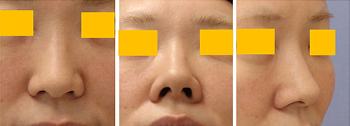 東京・渋谷の宮益坂クリニックの鼻翼縮小の症例写真（術前）