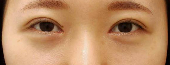 宮益坂クリニックの下眼瞼脱脂術＋眼窩脂肪移植の症例写真（術後）