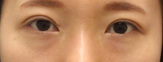 宮益坂クリニックの下眼瞼脱脂術＋眼窩脂肪移植の症例写真（術前）