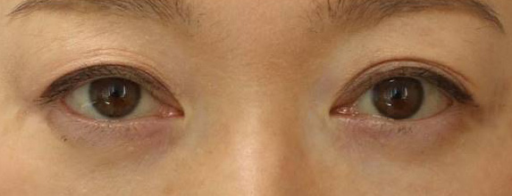宮益坂クリニックの下眼瞼脱脂術＋ヒアルロン酸注入の症例写真①（術後）