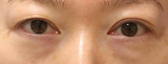 宮益坂クリニックの下眼瞼脱脂術＋ヒアルロン酸注入の症例写真①（術前）