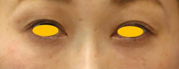 宮益坂クリニックの下眼瞼脱脂術＋ヒアルロン酸注入の症例写真②（術後）