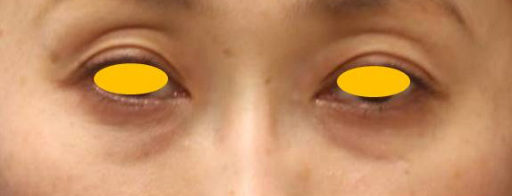 宮益坂クリニックの下眼瞼脱脂術＋ヒアルロン酸注入の症例写真②（術前）
