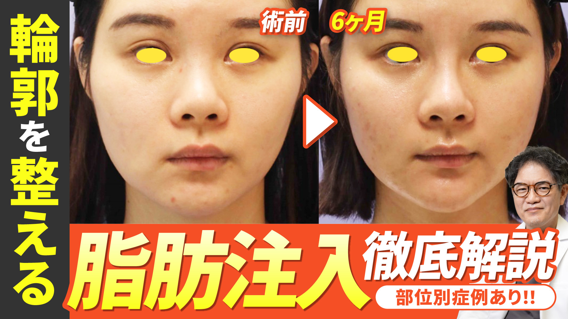 輪郭を整える脂肪注入徹底解説