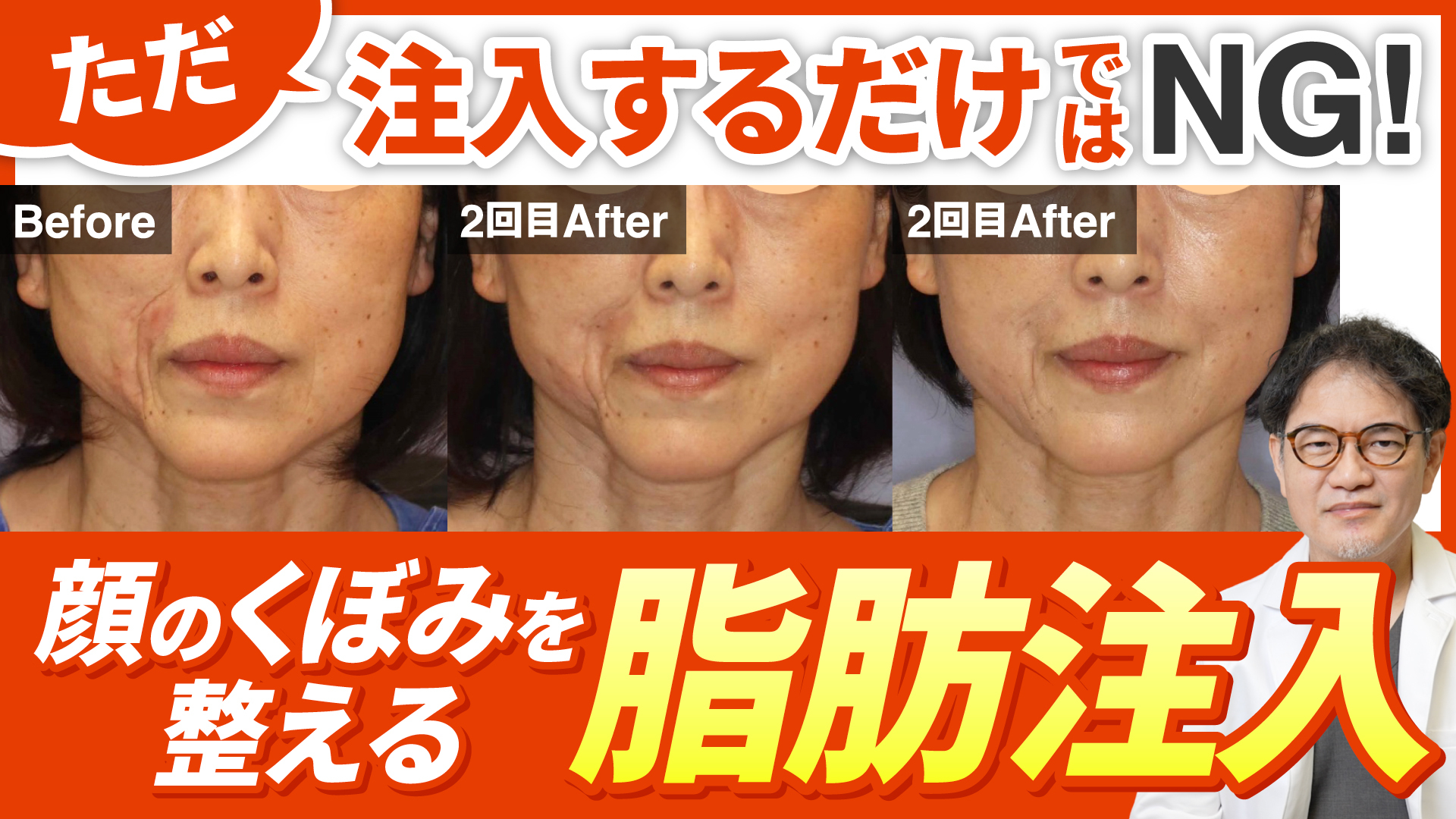 顔のくぼみを整える脂肪注入