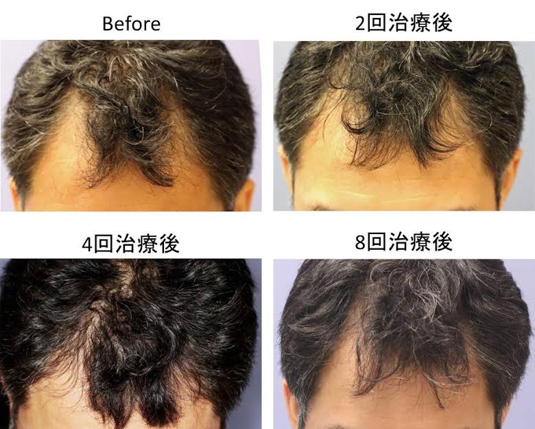 宮益坂クリニックのヘアフィラーによる薄毛治療の症例