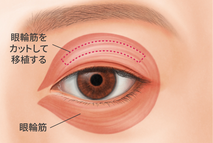 宮益坂クリニックの筋原性眼瞼下垂症の解説