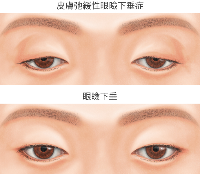 宮益坂クリニックの皮膚弛緩性眼瞼下垂症の解説