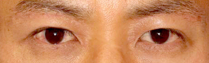 眼瞼下垂手術の症例写真（術後）