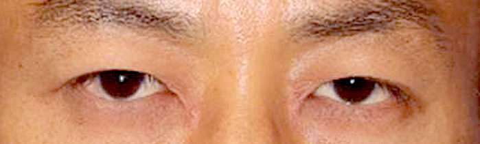 眼瞼下垂手術の症例写真（術前）