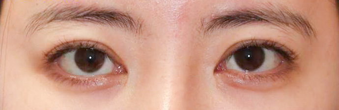 宮益坂クリニックの埋没法3点留め＋上眼瞼脱脂術の症例写真（術後）