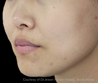 症例写真（治療後）