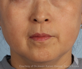 症例写真（治療後）