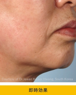 症例写真（治療後）