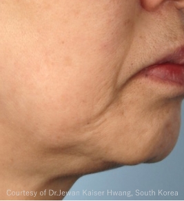 症例写真（治療前）