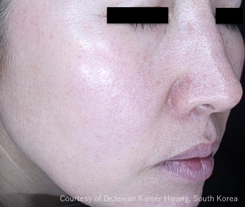 症例写真（治療後）