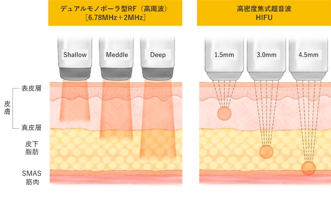 RF（高周波）とHIFUとの違い