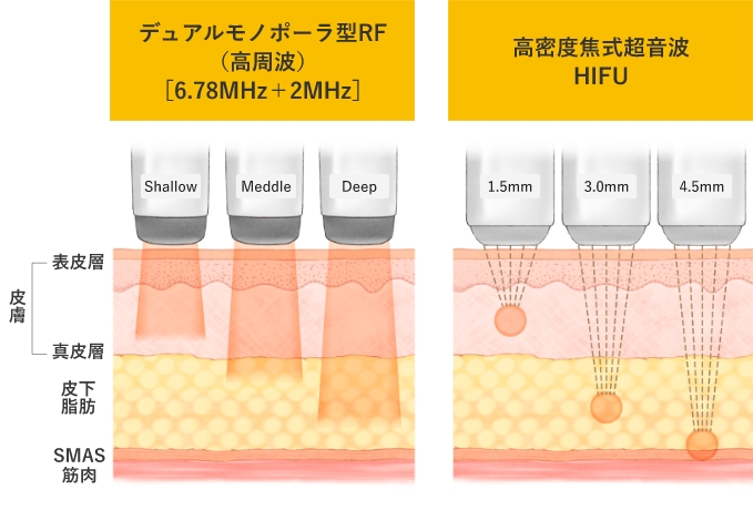 RF（高周波）とHIFUとの違い
