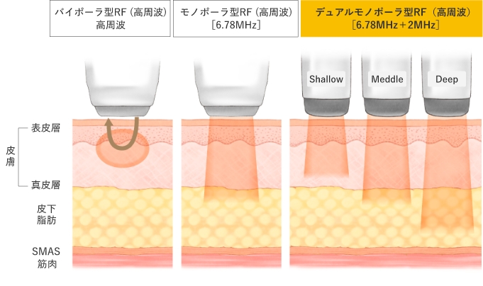 RF（高周波）の特徴
