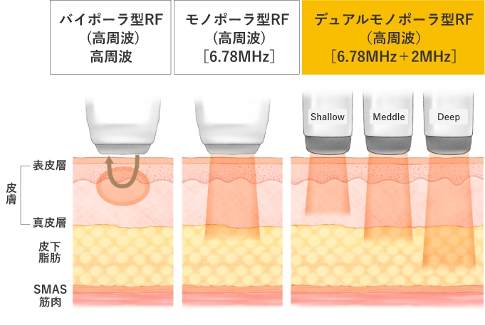 RF（高周波）の特徴