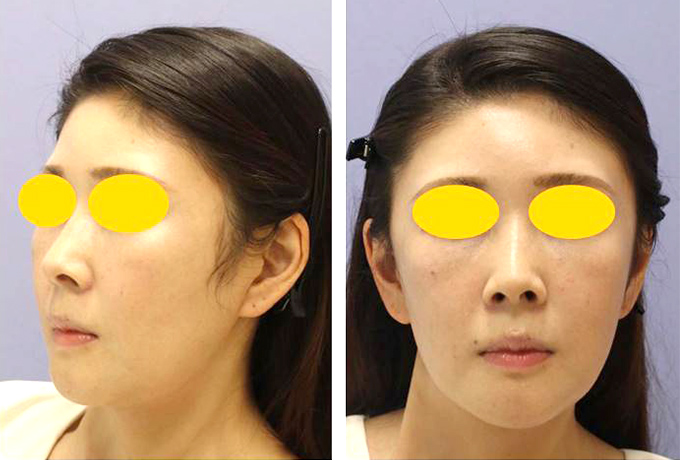 中下顔面・首のミニフェイスリフト＋脂肪注入の症例写真（術前）