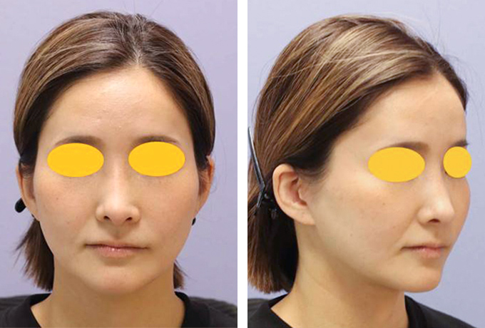 中下顔面・首のミニフェイスリフトの症例写真（術後）