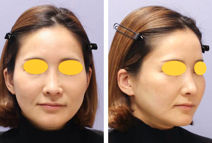 中下顔面・首のミニフェイスリフトの症例写真（術前）
