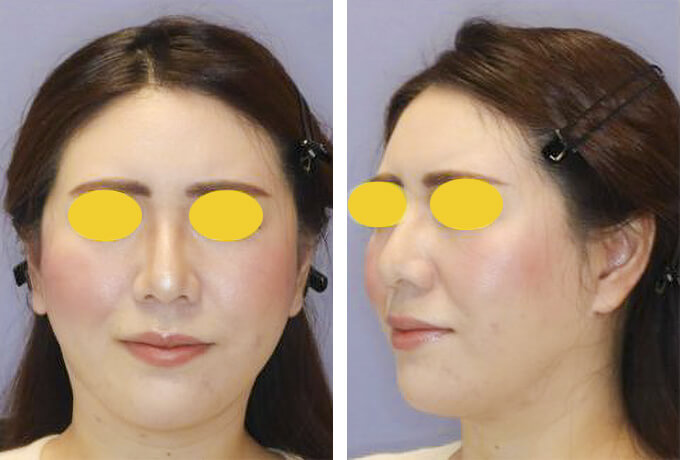 下顔面・首のミニフェイスリフトの症例写真（術前）
