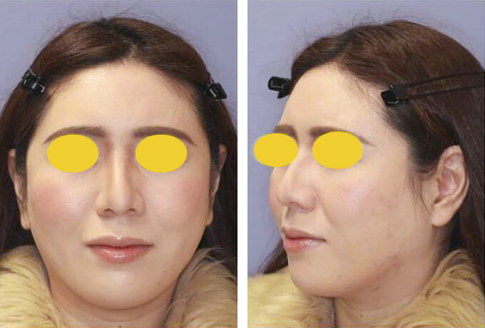 下顔面・首のミニフェイスリフトの症例写真（術前）